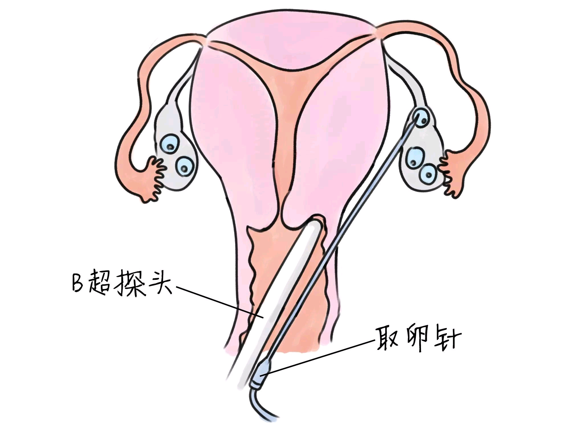 代孕