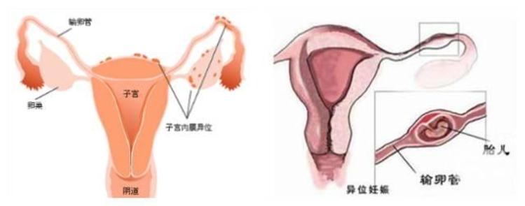 代孕