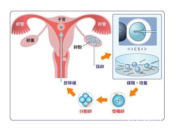 代孕