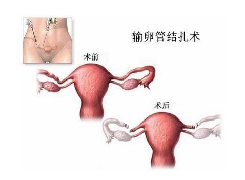 供卵不用等